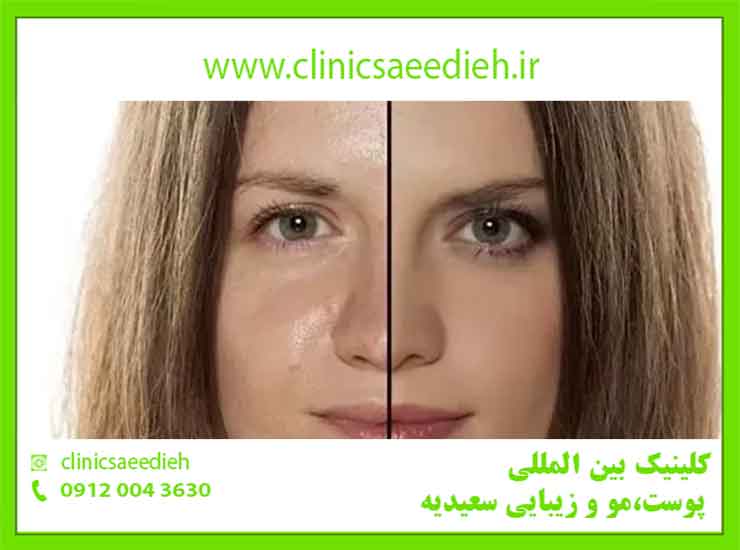 کلینیک زیبایی سعیدیه - راهکارهای خانگی و دارویی درمان چربی پوست
