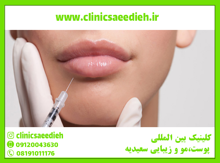 تزریق ژل لب مدل روسی - کلینیک پوست و مو زیبایی سعیدیه