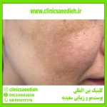 سریعترین راه از بین بردن لک صورت چیست؟